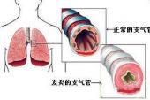 用“支气管炎”造句