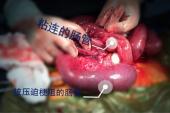 用“肠粘连”造句